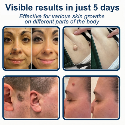 ✅🇦🇺𝐇𝐞𝒂𝒍𝗿𝗶𝙯𝙚®2-in-1 Microneedle & Hydrocolloid Patch🛤️| Removes Raised Moles, Acne, Flat Warts & Skin Tags | Helps Improve Wrinkles, Scars & Blemishes | Invisible Patches for Face & Body（副本）