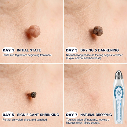 🍲 Official Store | Healrize® 🖊 Skin Tag & Spot Remover in 7 Days (Zero Pain, Zero Scarring – Precise Roller) 👩
